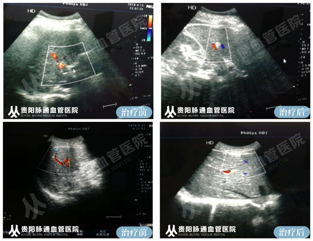 【贵阳血管瘤治疗案例】智能腔内综合治疗前后对比6